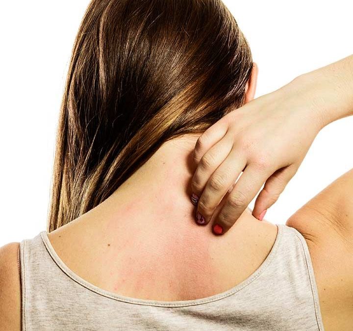gatal akibat bedbugs